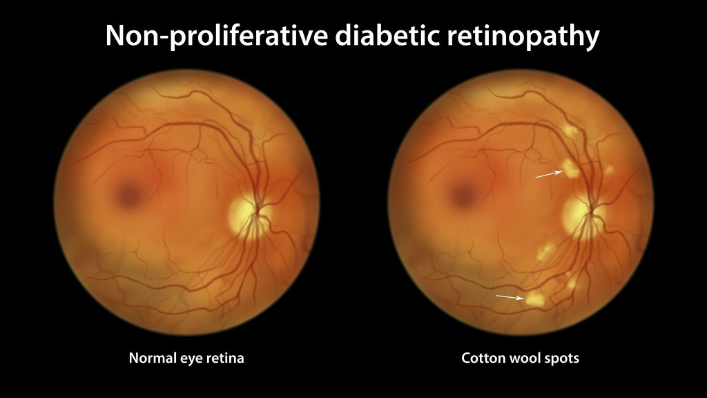 non-proliferative-diabetic-retinopathy-illustration