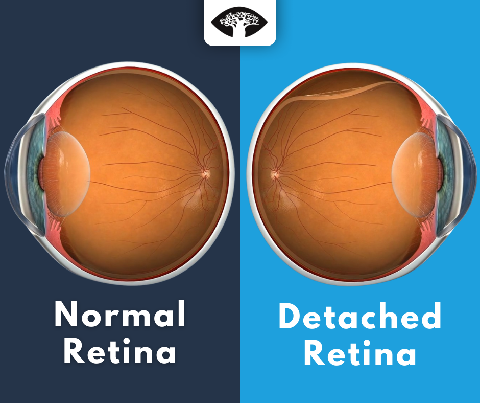 Infographic showing the difference between a normal eye and an eye with retinal detachment