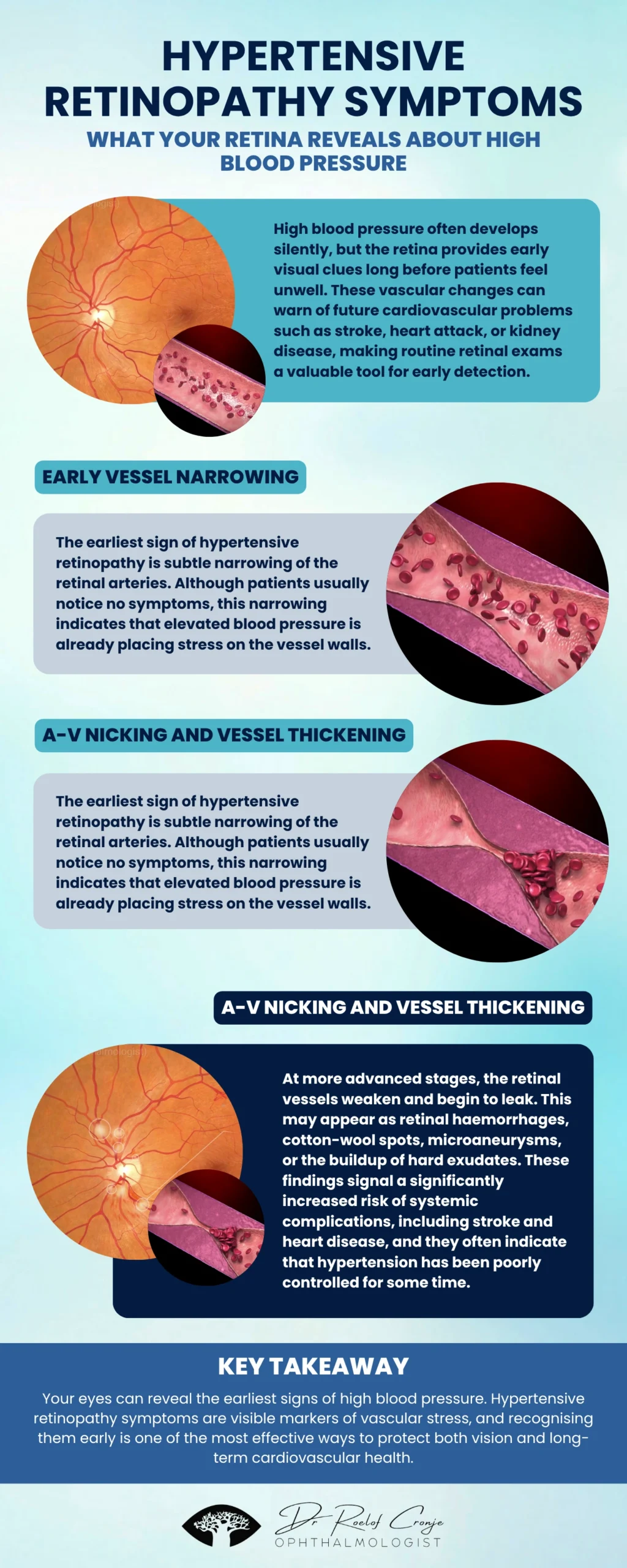 Infographic explaining hypertensive retinopathy symptoms, showing retinal vessel narrowing, A-V nicking, retinal leakage, optic nerve swelling, and referral guidance for high blood pressure detection.
