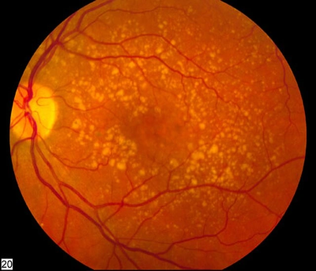Advanced age-related macular degeneration fundus photograph showing extensive drusen deposits across the macula
