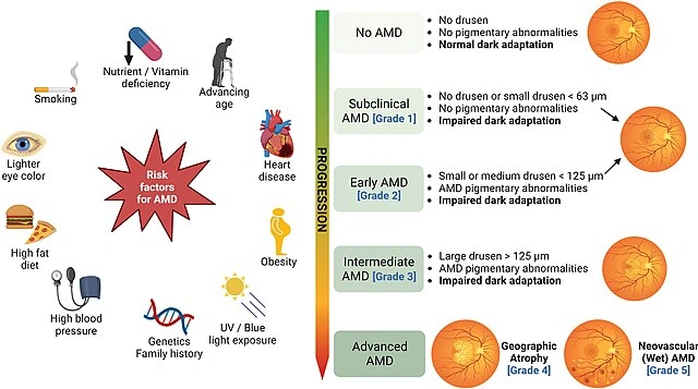 Diagram showing stages of age-related macular degeneration progression from normal retina to advanced disease with risk factors