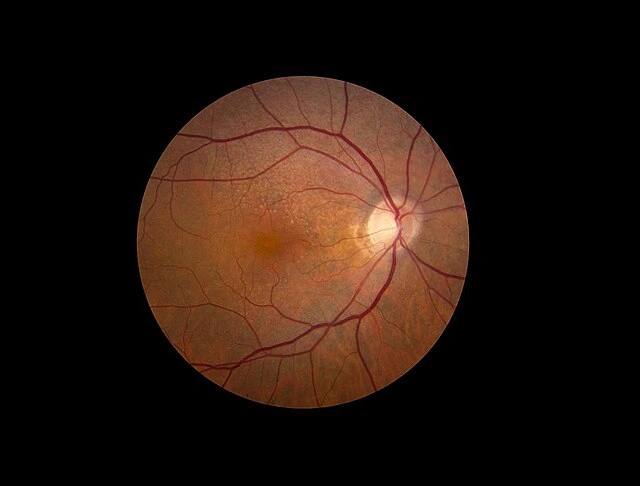 Fundus photograph showing reticular pseudodrusen with subtle yellowish deposits in the retina associated with early macular degeneration